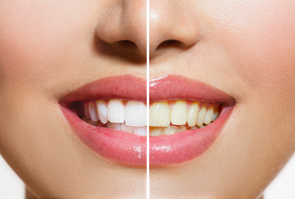 To learn about professional teeth whitening in Hayward, call Dr. Fong at 510-582-8727 today